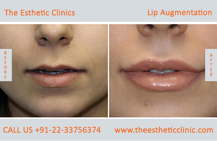 Lip Augmentation, Lip Enlargement, Lip Implant Surgery before after photos in mumbai india (1)
